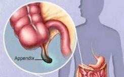發(fā)現(xiàn)闌尾炎和過敏癥之間的聯(lián)系
