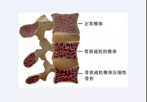 講解早期骨質(zhì)疏松都有哪些癥狀以及怎么飲食補鈣